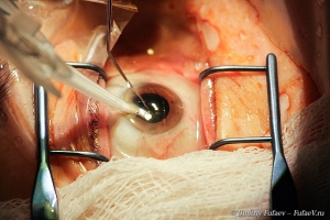 Операция на глазу. Фото Дмитрия Фуфаева.Фотограф медицины. Операции.